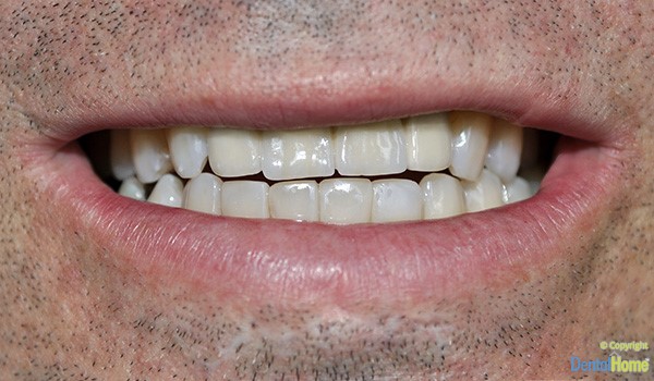 puentes-dentales-medellin-para-dientes-caso--3-despues