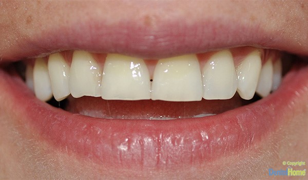 tratamiento-Carillas-en-resina-Medellin-clinica-dental-home-antes-caso-9