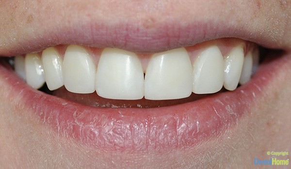 tratamiento-Carillas-en-resina-Medellin-clinica-dental-home-despues-caso-9