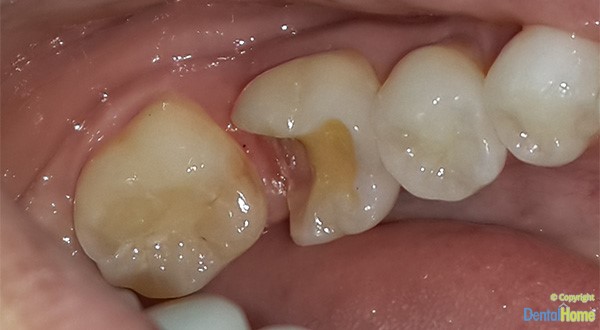 caso-incrustaciones-dentales-medellin-antes