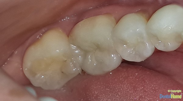 caso-incrustaciones-dentales-medellin-despues