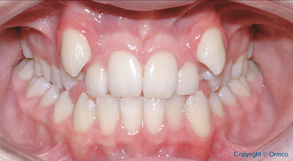 casos-ortodoncia-medellin-dental-home 1 antes