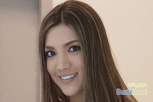 ¿Cuáles son las ventajas de los Lentes de contacto dentales?