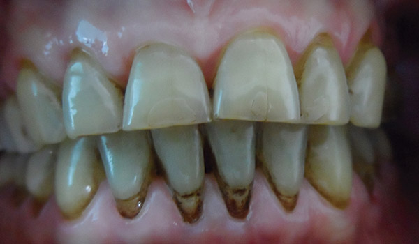 Caso higiene-oral-medellin. Antes de la limpieza dental