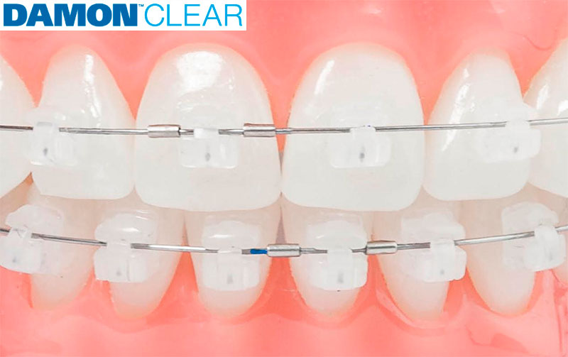 Brackets transparentes en tu Ortodoncia con DentalHome