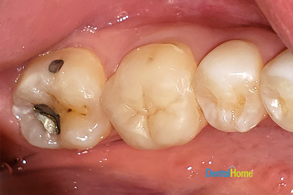 caso 2 cambio-de-amalgamas-por-resinas-en-medellin. Antes del cambio