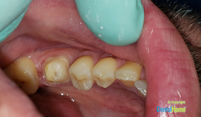 coronas-en-zirconio-colombia-medellin-antes-despues-1