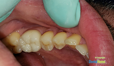 coronas-en-zirconio-colombia-medellin-antes-despues-2