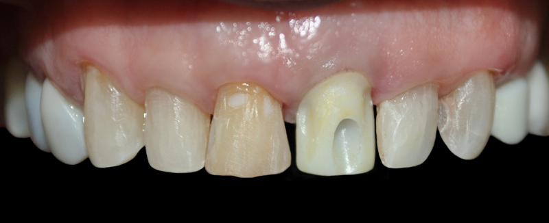 clinica implantes dentales medellin 2