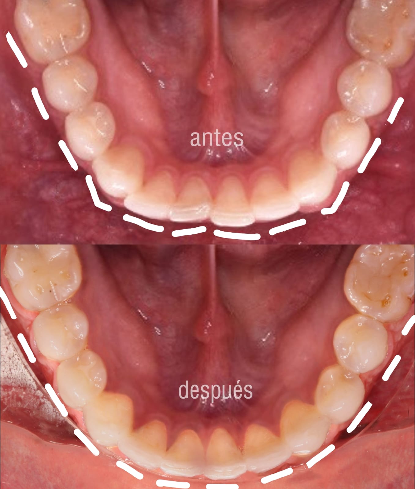 comparacioón resultados alineadores -dentales u ortodoncia invisible antes ydespues
