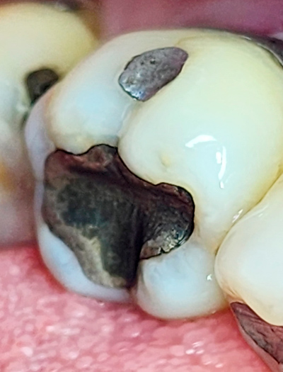 Reemplazo-amagalmas-por-resinas-B1