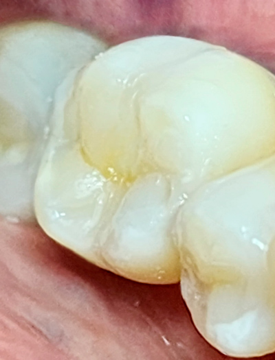 Reemplazo-amagalmas-por-resinas caso 4 despues