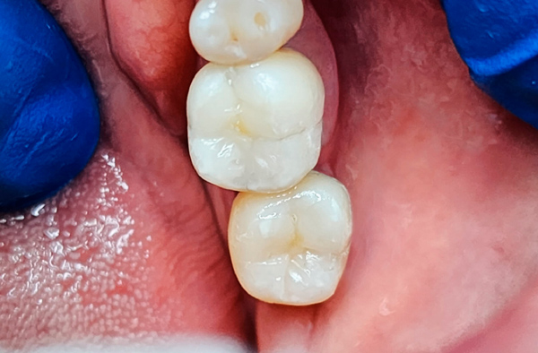 Después del Reemplazo de amagalmas-por-resinas