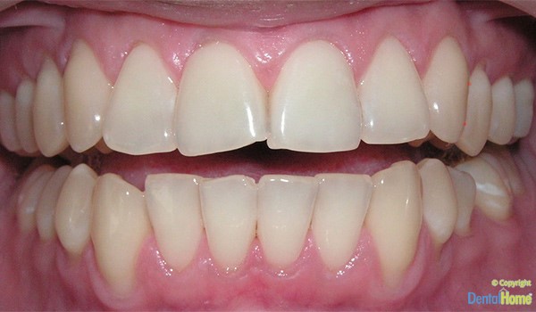 blanqueamiento dental medellin con cubetas caso 1 antes