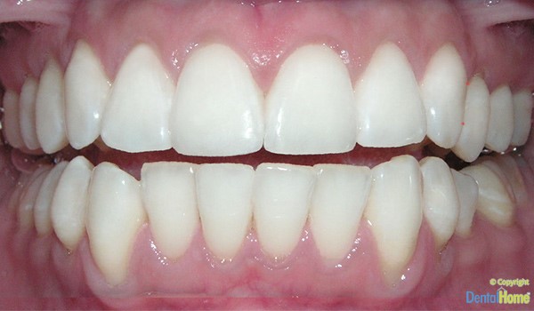 blanqueamiento dental medellin con cubetas caso 1 después