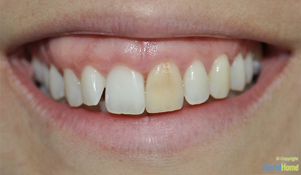 cambio-de-color-dientes-lentes-de-contacto-medellin-discromia-caso-7-antes