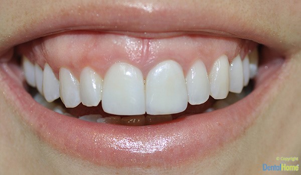cambio-de-color-dientes-lentes-de-contacto-medellin-discromia-caso-7-despues