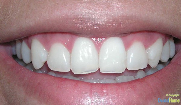 carillas-en-resina-estetica-dental-home-7-antes