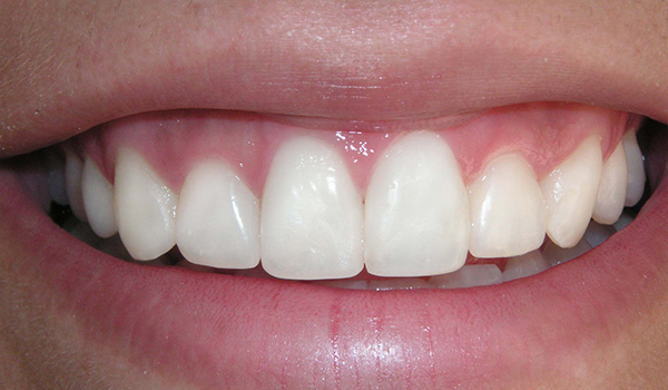 carillas-en-resina-estetica-dental-home-7-despues