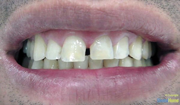 carillas-resina-medellin-caso-4-antes