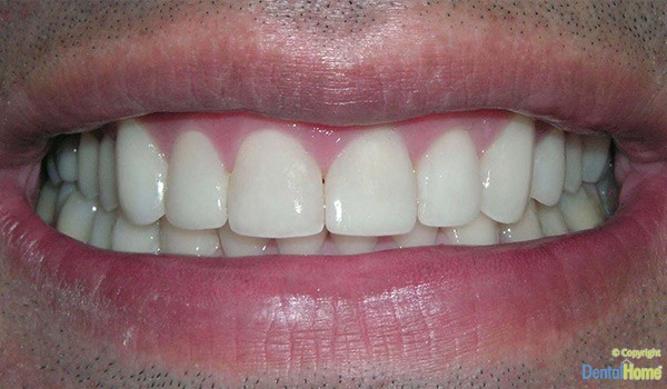 carillas-resina-medellin-caso-4-despues