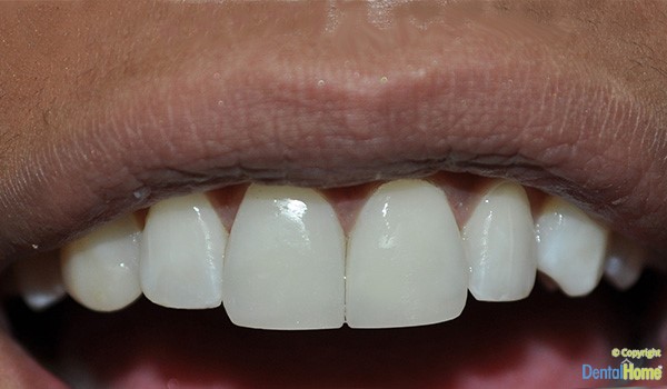 correccion-de-fractura-con-carilla-despues