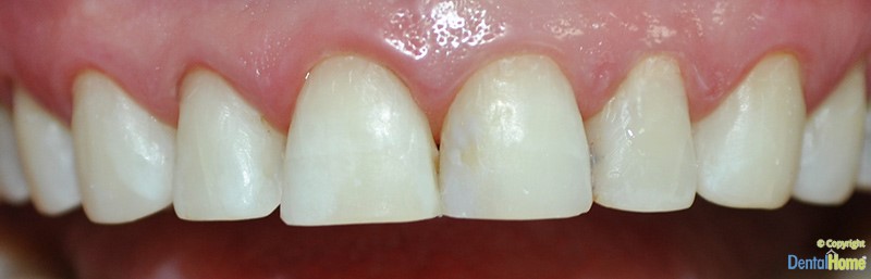 lentes-de-contacto-dental-home-dentales-estetica-antes-1