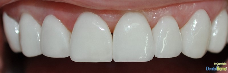 lentes-de-contacto-dental-home-dentales-estetica-despues-1