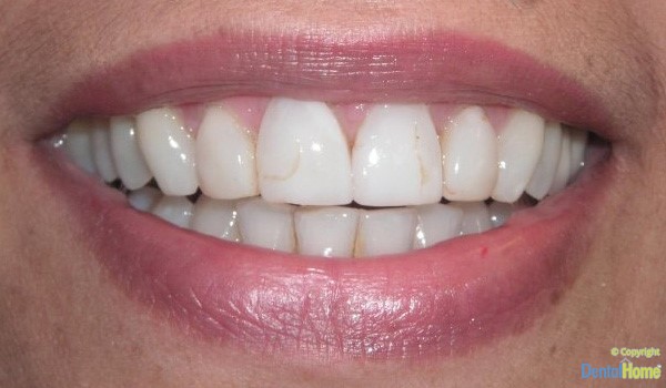 lentes-de-contacto-dentales-para-dientes-colombia-caso-9-antes