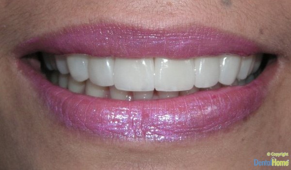 lentes-de-contacto-dentales-para-dientes-colombia-caso-9-despues